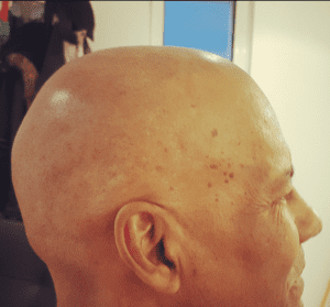 Bald man before scalp micropigmentation