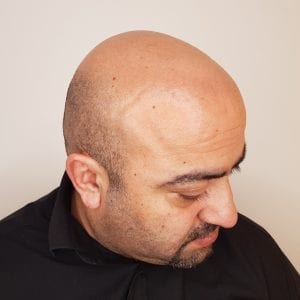 scalp micropigmentation before