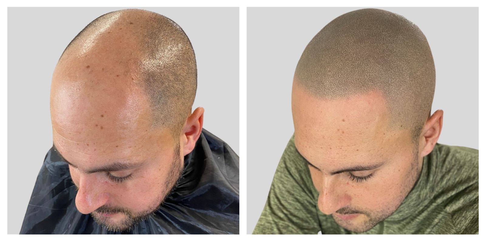 Scalp Micropigmentation before and after