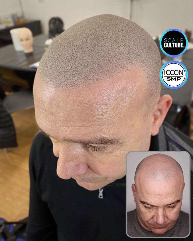 Hair tattoo result on a previously bald head, with the before photo inset
