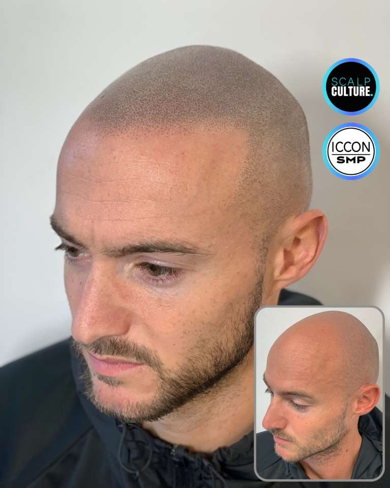 Hairline tattoo result restoring a receding hairline to a natural edge, with the before photo inset