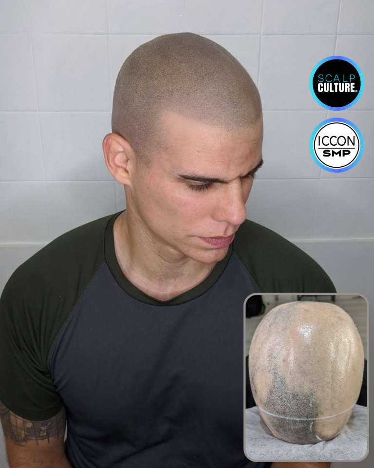 A closely shaved look after a hair tattoo for a bald head, with the bald before photo inset