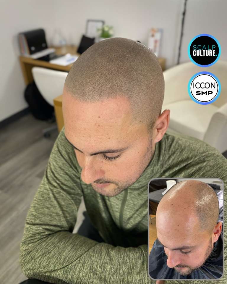 Scalp micropigmentation result across the crown and hairline, with the before photo inset