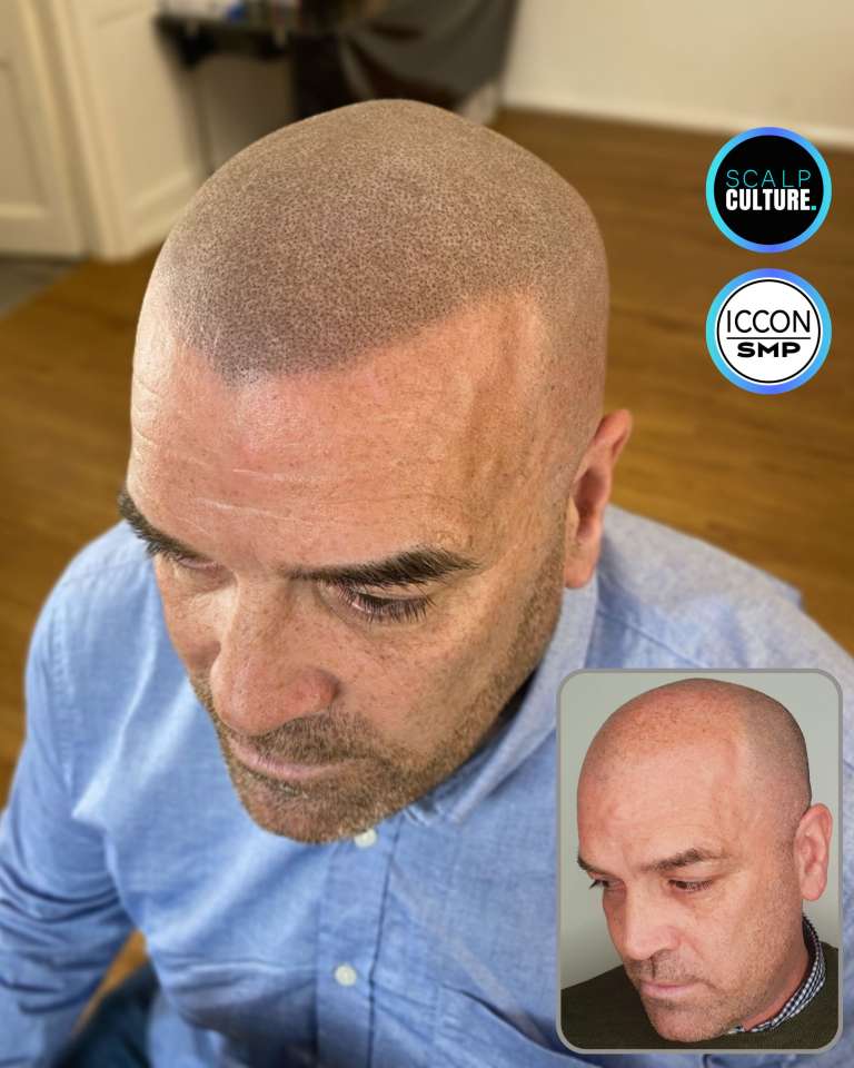 Finished scalp micropigmentation on a male client at the Birmingham clinic, before photo inset