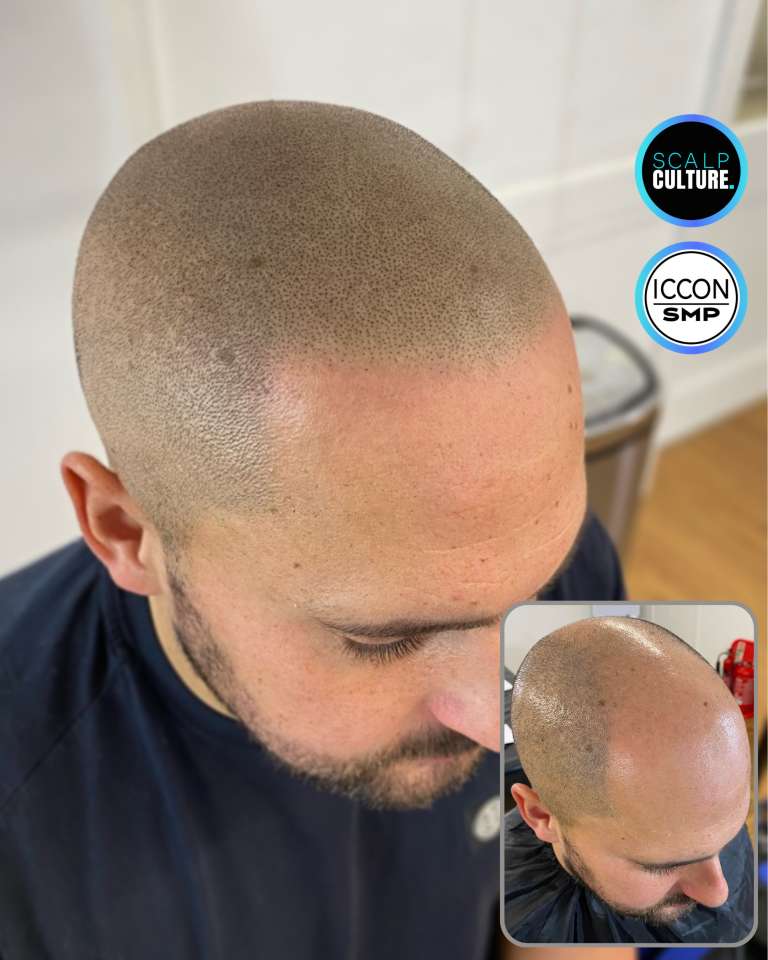 Close-up of a natural scalp micropigmentation result showing fine pigment dots across the scalp